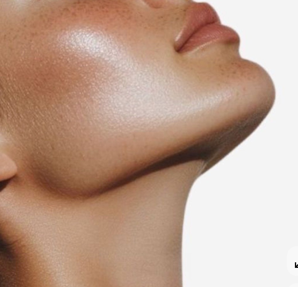 Lipoenzimática de Papada - Estética Facial en Córdoba