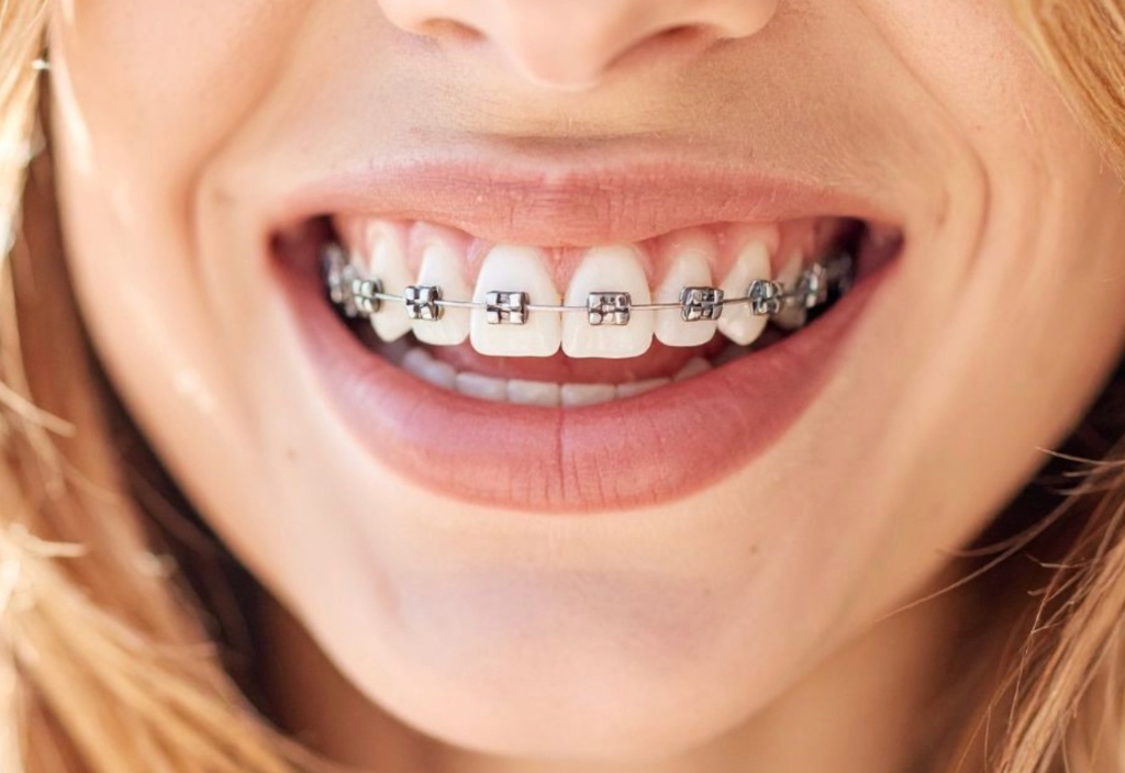 Tratamiento de Ortodoncia en Córdoba - Dra. Nazarena Quesada